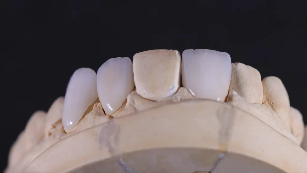 ProtesisFijas_Servicios_13