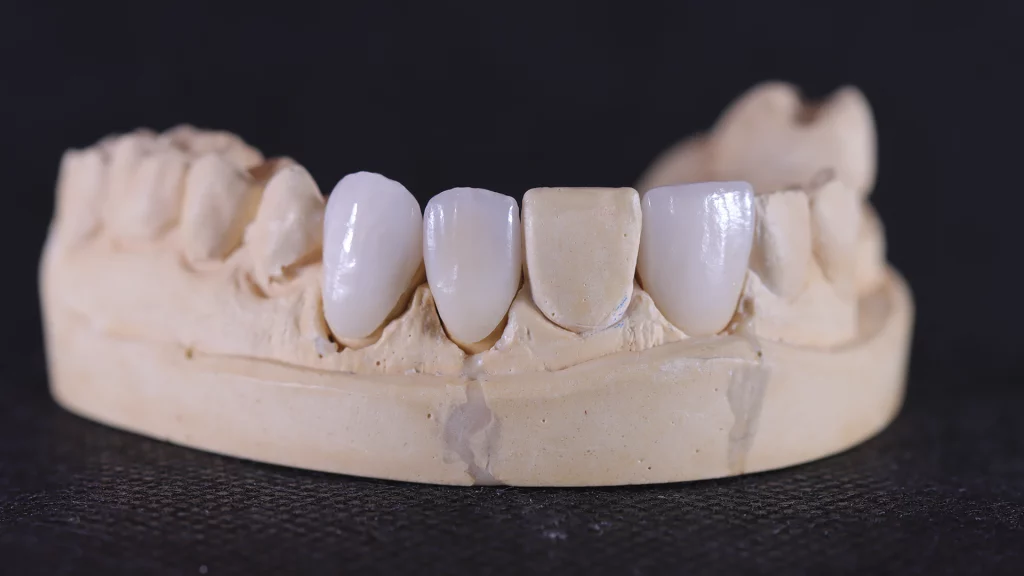 ProtesisFijas_Servicios_14