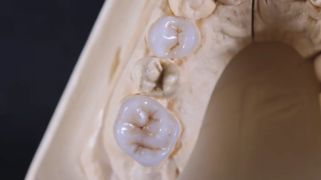 ProtesisFijas_Servicios_15