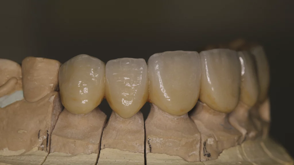 ProtesisFijas_Servicios_16_metalceramica