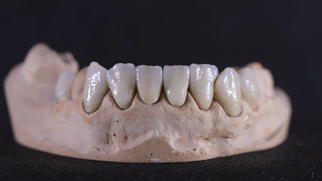 ProtesisFijas_Servicios_17_metalceramica