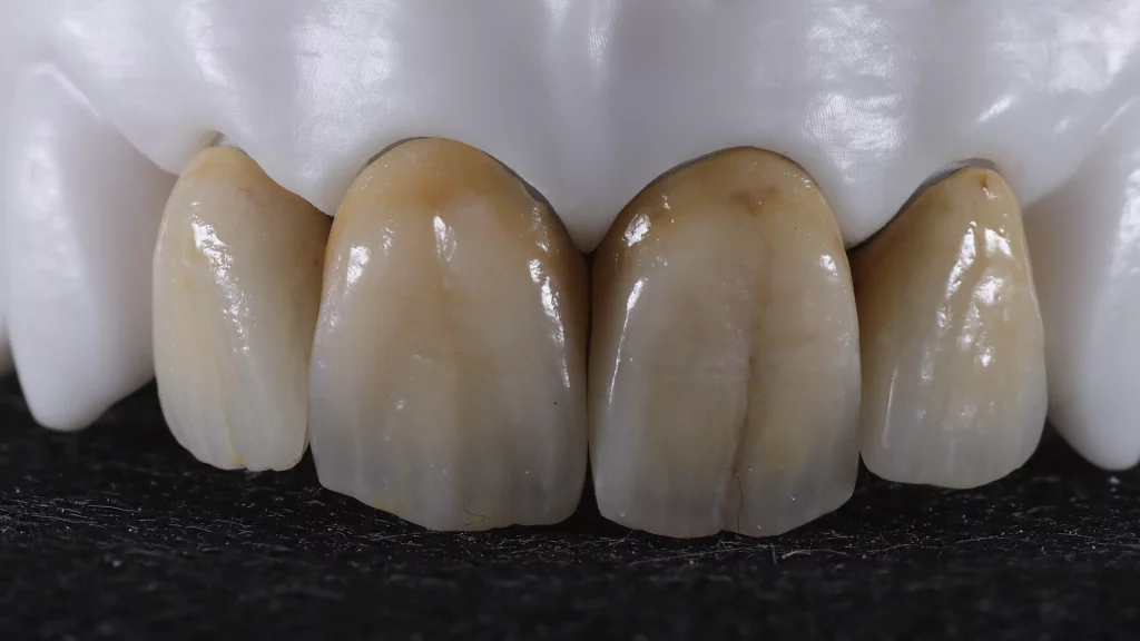 ProtesisFijas_Servicios_24_metalceramica