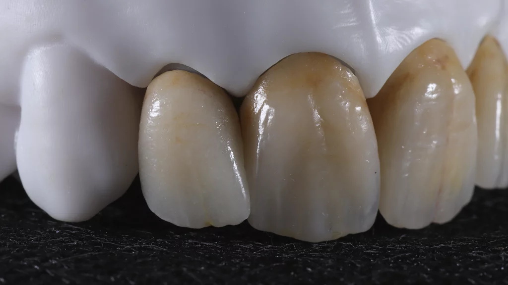 ProtesisFijas_Servicios_25_metalceramica