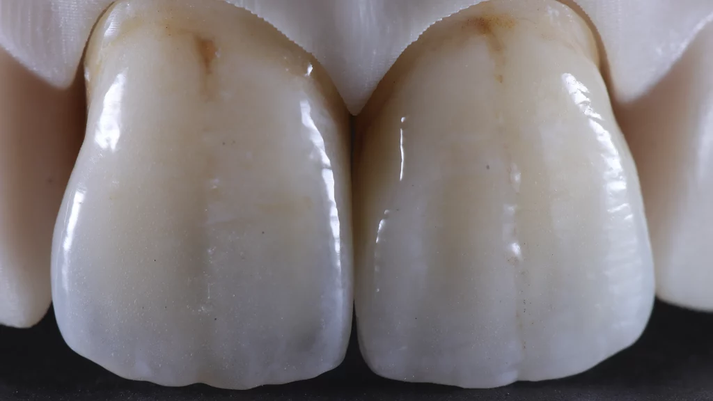 ProtesisFijas_Servicios_26_metalceramica