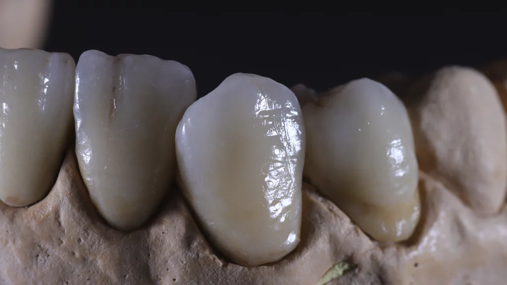 ProtesisFijas_Servicios_29_metalceramica