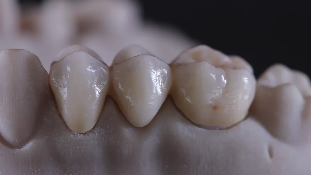 ProtesisFijas_Servicios_3