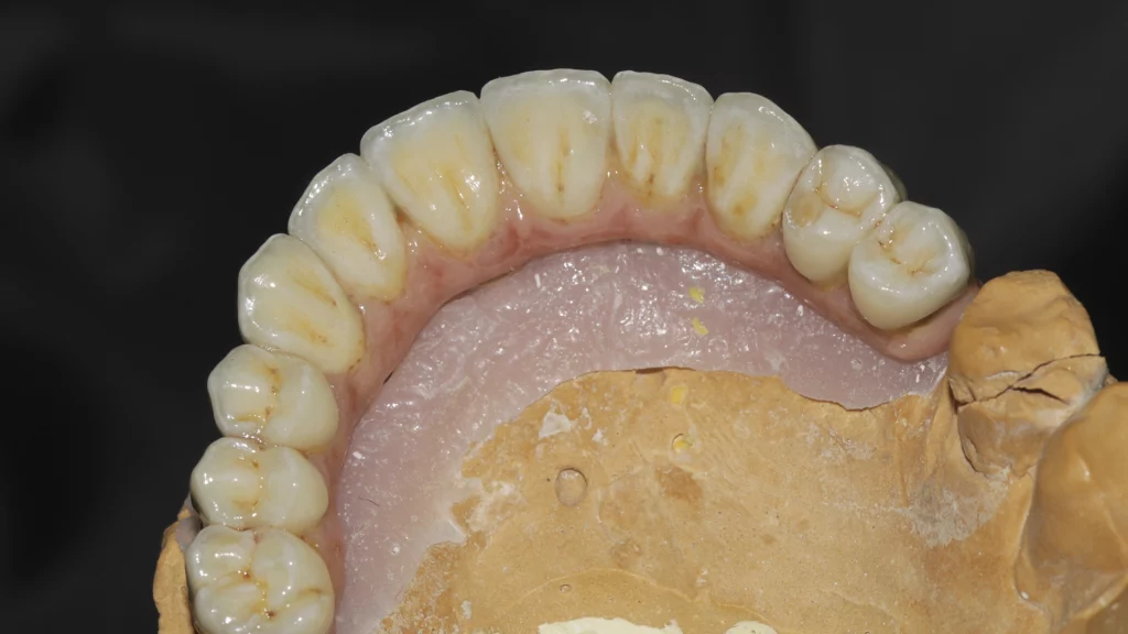 protesis_implantes_Servicios_4